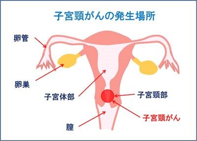 子宮頸がん発生場所